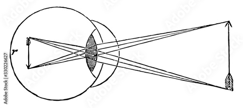 Cornea too Convex on Eye, vintage illustration.