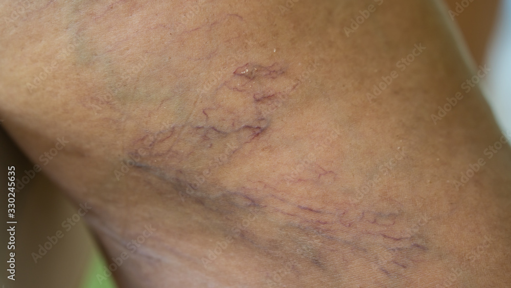 Varicose veins on young women legs Varicose veins on young women legs