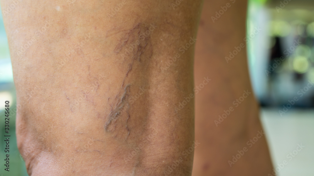 Fototapeta premium Varicose veins on young women legs