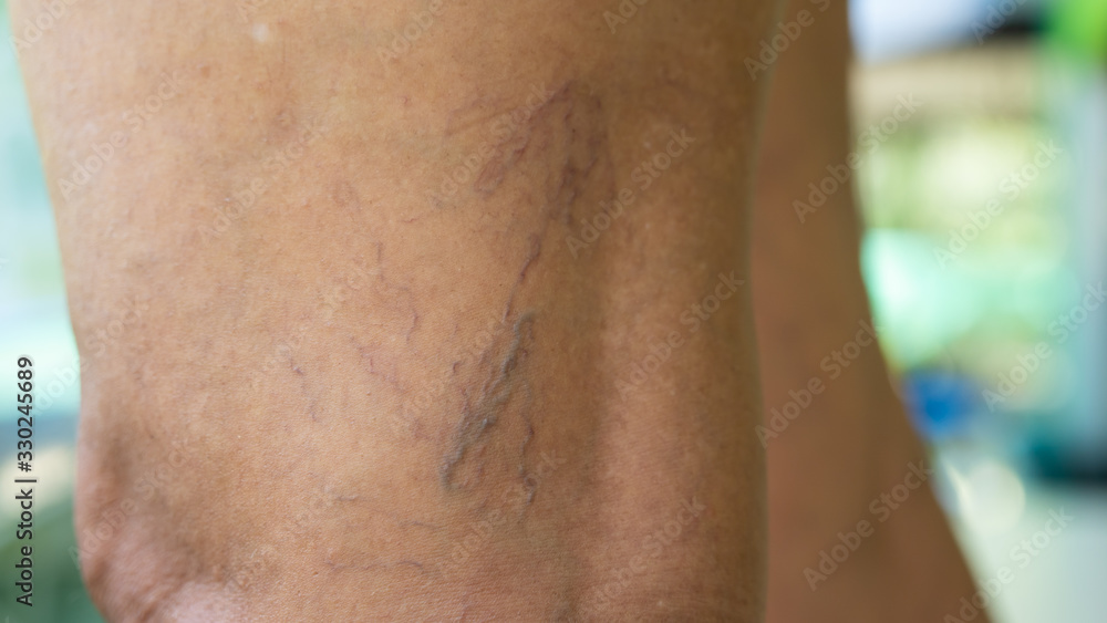 Fototapeta premium Varicose veins on young women legs