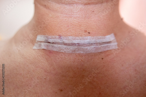Close up of thyroid operation scar of a man with adhesive bandage is still intact.