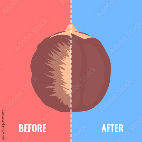 Top view portrait of a woman before and after hair treatment and  transplantation. Divided image of the head on red and blue background. Two halves.  Beauty health care concept. Vector illustration.