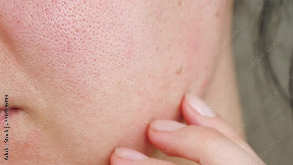 Macro skin with enlarged pores. The girl touches the irritated red skin with her fingers. Allergic reaction, peeling, care for problem skin. Beauty and cosmetology. Macro skin with enlarged pores. The girl touches the irritated red skin with her fingers. Allergic reaction, peeling, care for problem skin. Beauty and cosmetology.