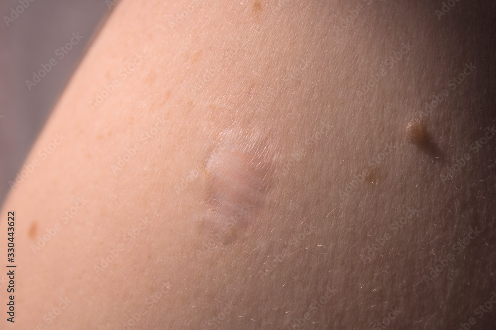 Fototapeta premium Skin problems. Scar after a medical operation to remove moles on the shoulder.