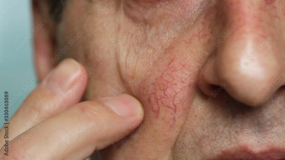 Man's face skin with vascular stars and couperose. Close up view of capillaries on the skin, telangiectasias Man's face skin with vascular stars and couperose. Close up view of capillaries on the skin, telangiectasias