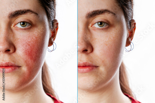 Obraz na plátně A close-up portrait of a young Caucasian woman showing redness and inflamed blood vessels on her cheeks
