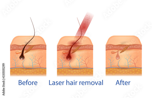 Anatomical Training Poster, Aid, Before and After Hair Removal Procedure. Anatomy Cross Section of Skin Layers. Red Laser Light Beam Damage Follicle. 3D Vector Realistic Illustration, Medical Banner
