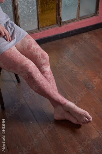 View of leg and foot with Psoriasis