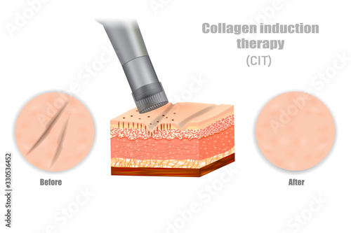 Collagen induction therapy (CIT). DERMAPEN. Microneedle stamping device.  photo