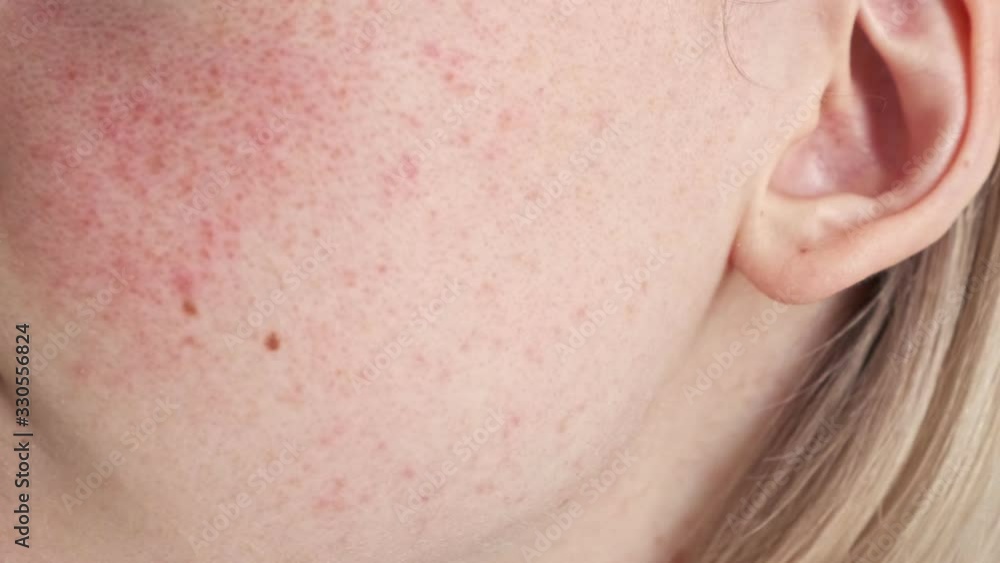 Close up of skin problems, unhealthy skin with acne and pimples. Porous, demodex and rosacea, red rashes. The concept of care for problem skin. Allergic and redness. Close up of skin problems, unhealthy skin with acne and pimples. Porous, demodex and rosacea, red rashes. The concept of care for problem skin. Allergic and redness.