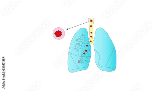 Schematic drawing of lungs with bronchi and alveoli with the Corona virus.