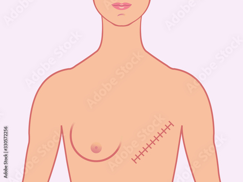 Female human form illustrated with the scars of a mastectomy.