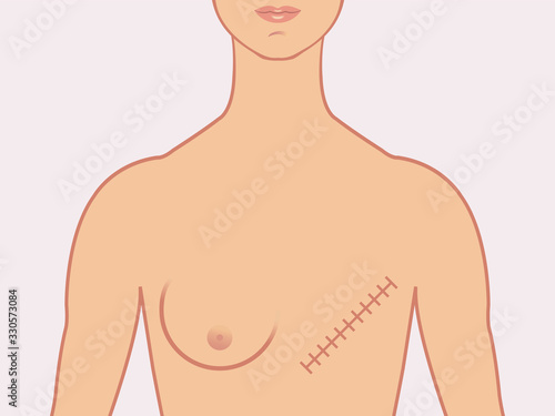 Female human form illustrated with the scars of a mastectomy