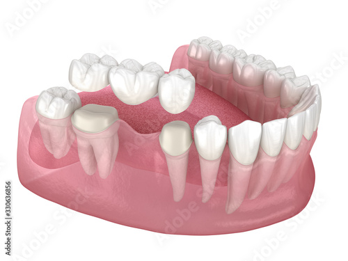 Dental bridge of 3 teeth over molar and premolar. Medically accurate 3D illustration of human teeth treatment photo