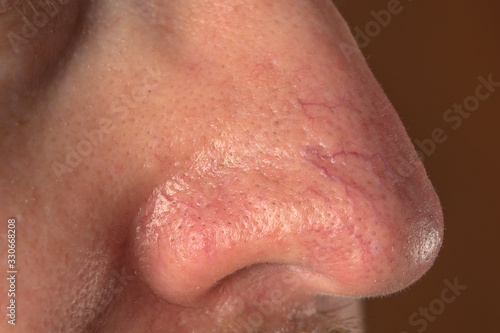the surface of the skin with rosacea and eczema