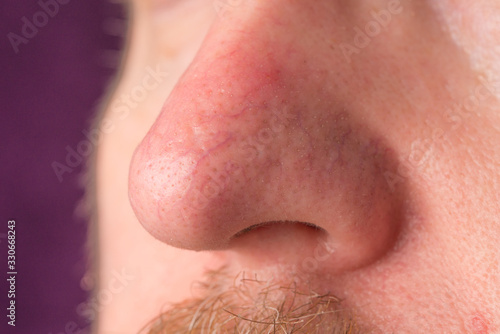 the surface of the skin with rosacea and eczema