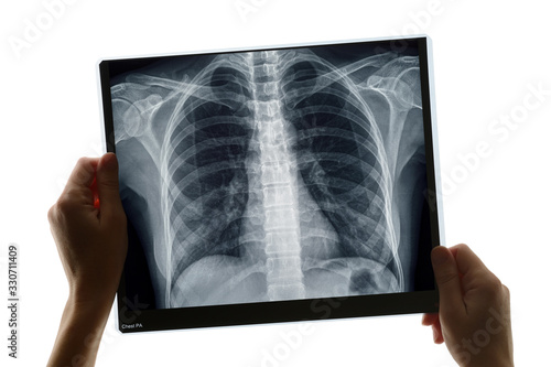 Examination of a chest x-ray photo