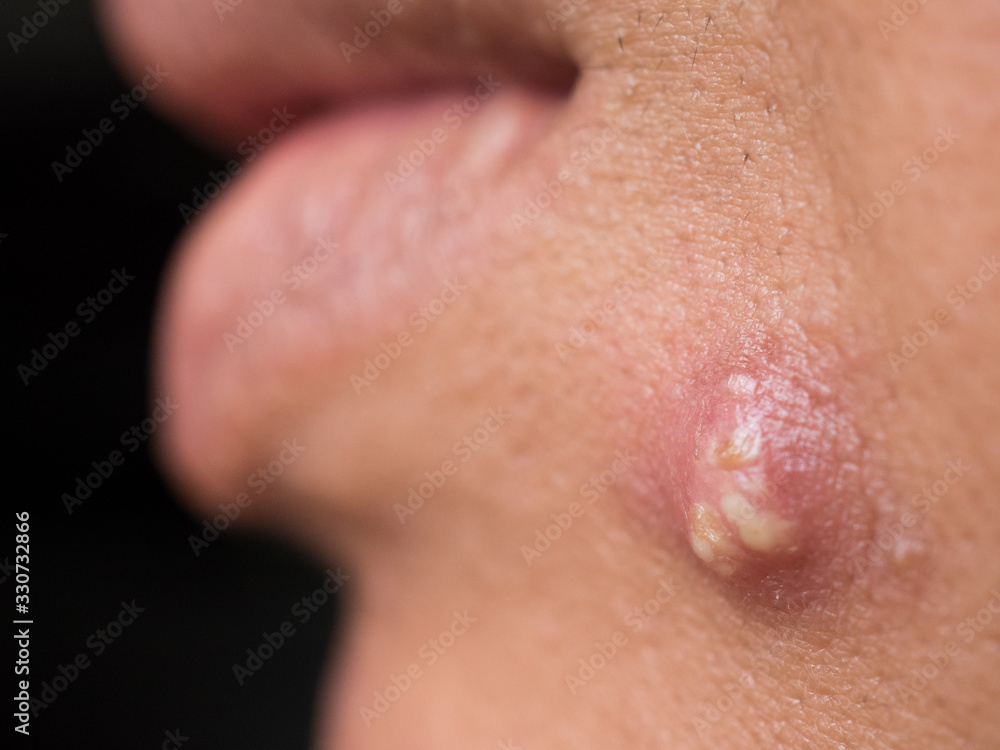 pimple extreme on human skin, large pimple, macro pimple extreme on human skin, large pimple, macro