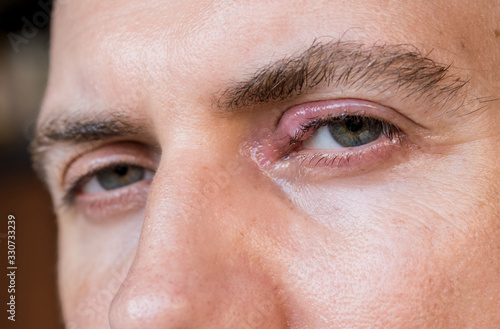 Eye infection. Eye disease. Swollen men's eye. Closeup