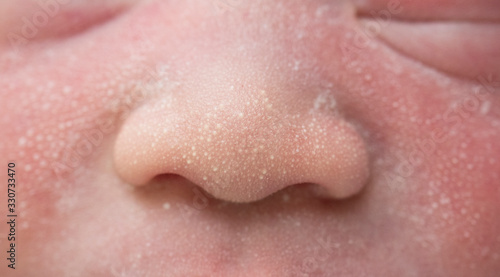 Foto Macro, close-up shot of the milia on a two day old baby cheek, nose and forehead