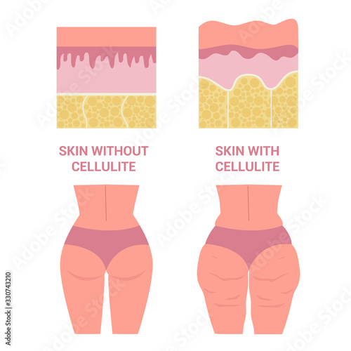 Young woman thighs with and without cellulite. Girl in underwear