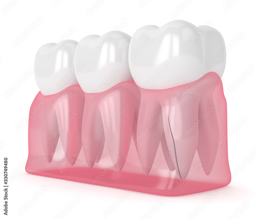 3d render of gum with cracked tooth root 3d render of gum with cracked tooth root