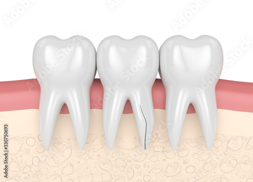 3d render of gum with cracked tooth root