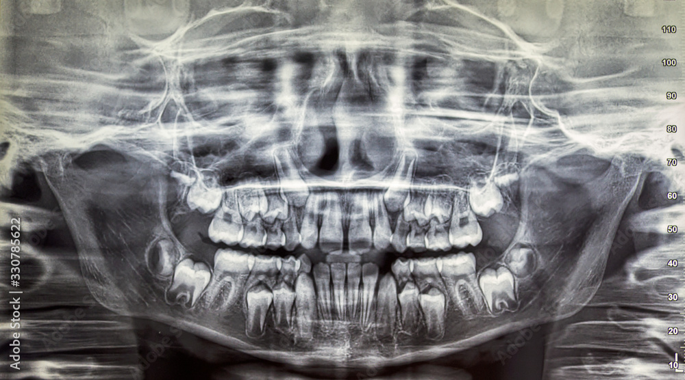 Ortopantomography Orthopantomography of an adult patient,digital radiographic acquisition ...