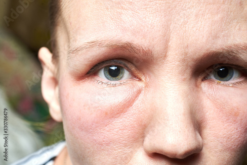 Swollen face of a woman under the eyes, swelling. An allergic reaction to drugs, cosmetics. photo
