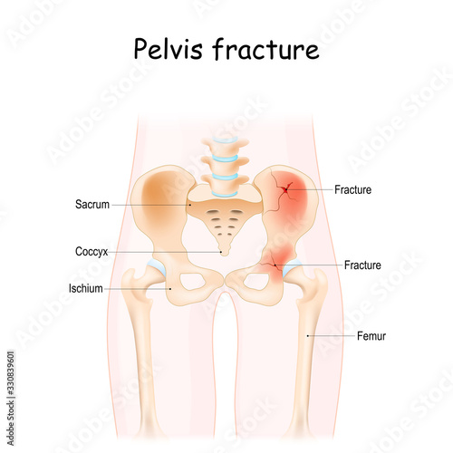Pelvis Fracture