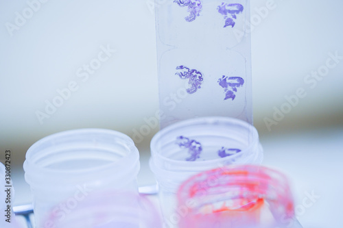 Scientist is preparing a tumor slide. Microscopy of cytopathology slides and pathology. photo