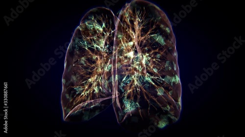 Corona virus is destroying the lungs. The lungs are going to be very damaged. photo