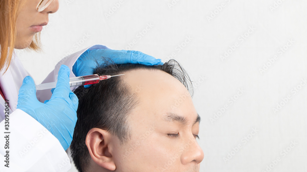 Close up of a bald man receiving injection in scalp from doctor. Man's head  with gloves holding syringe on white background. Hair loss problem,  alopecia treatment and hair growth concept. Stock Photo |