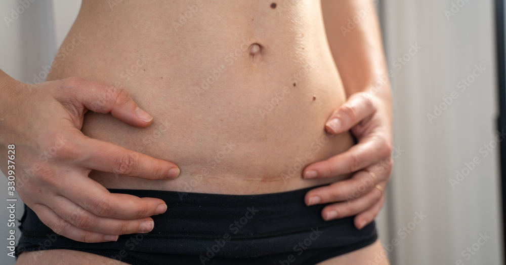 C-section scar on woman's belly. Childbirth in surgical way. Postpartum recovery C-section scar on woman's belly. Childbirth in surgical way. Postpartum recovery