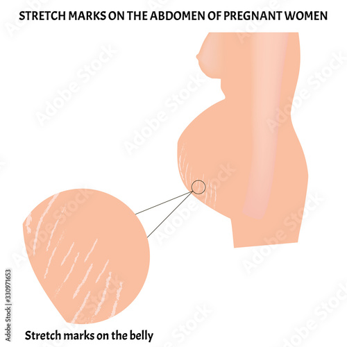 Stretch marks on the skin of the abdomen in a pregnant woman. Infographics. Vector illustration on isolated background