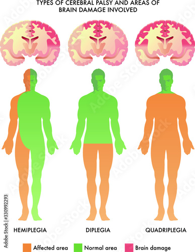 Medical illustration of types of cerebral palsy and areas of brain damage involved.
