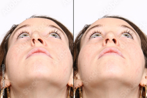 A comparison between the outcomes of nose reconstruction, before and after