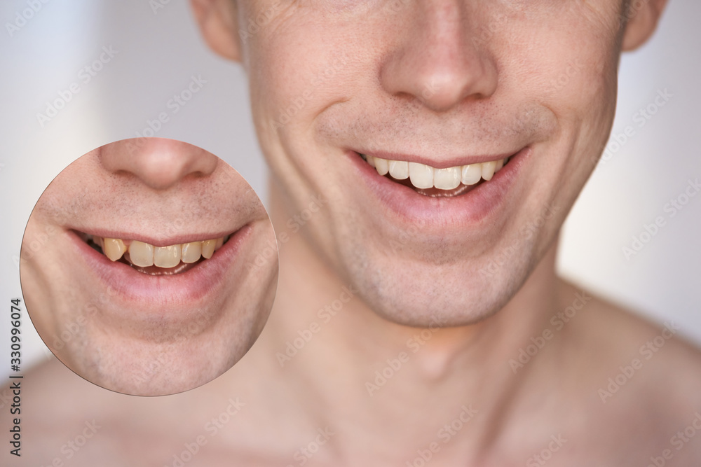 Men smile. Male smiling person. Whitening oral care concept. Teeth before and after. Laughing mounth. Yellow to white color