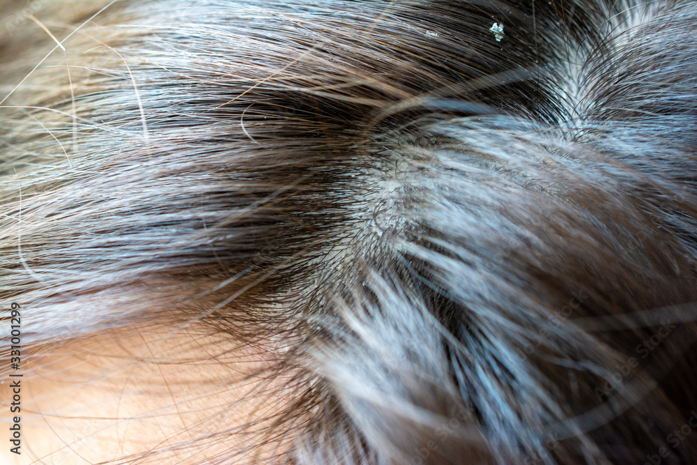Dandruff seborrhea problem of scalp and hair treatment of peeling from allergies. Scalp dermatoses. Fatty Dandruff.