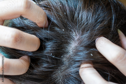 Dandruff seborrhea problem of scalp and hair treatment of peeling from allergies. Scalp dermatoses. Fatty Dandruff.