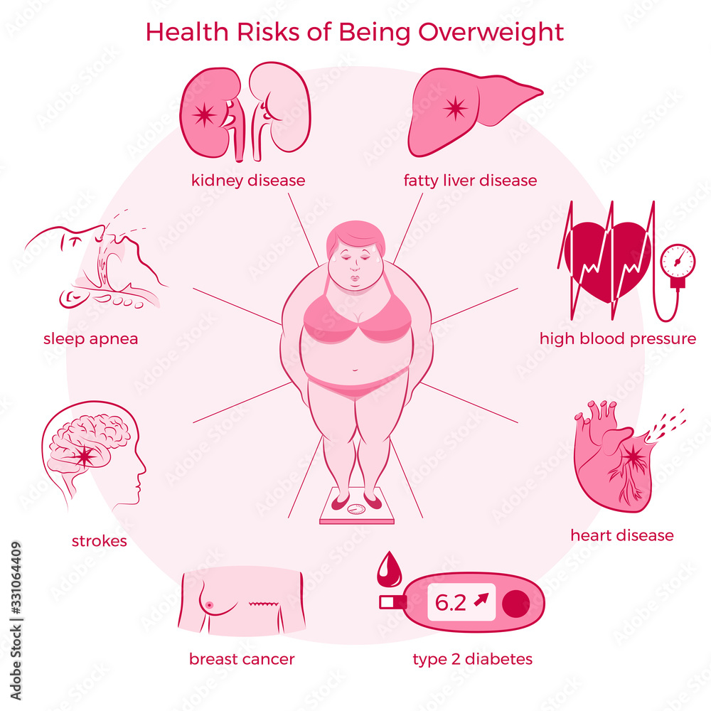 Health Risks of Being Overweight Set. Medicine, pathology, anatomy ...