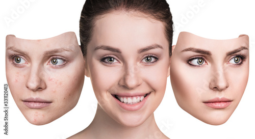 Woman wth acne before and after treatment and make-up.