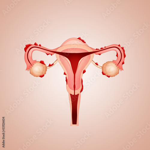 uterus with endometriosis photo