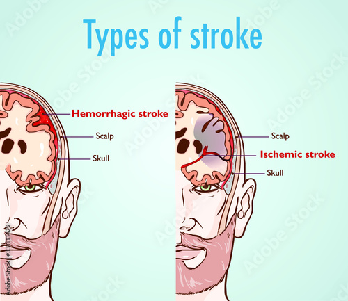 Hemorrhagic and ischemic stroke. photo