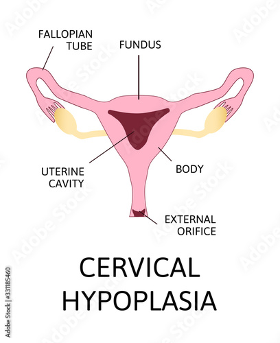 Uterine hypoplasia, naive uterus or infantile uterus.