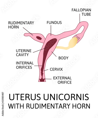 The shape of the uterus, the female reproductive organ. uterus unicornis