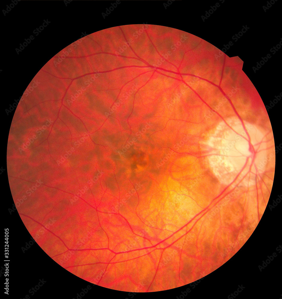 Ophthalmic image detailing the retina and optic nerve inside a healthy human eye. Medicine