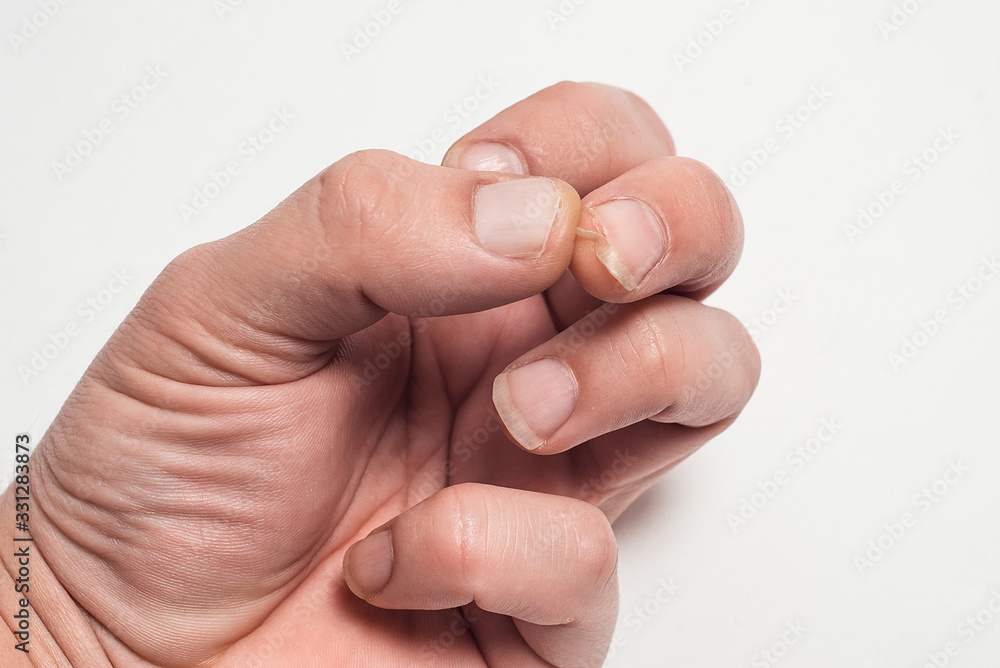 Close-up of brittle nails. A broken nail on your finger. Close-up of brittle nails. A broken nail on your finger.