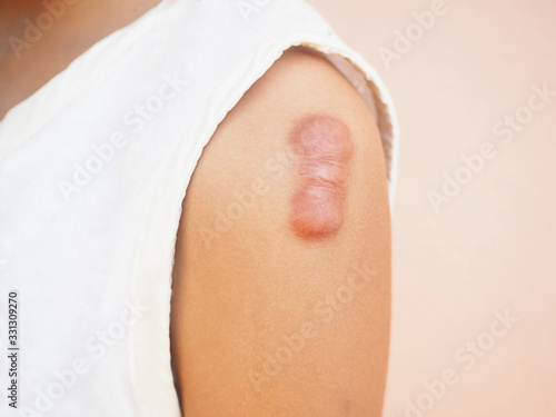 Keloid scar of skin shoulder kid girl case of tissue forms over the wound to repair and larger than the original and treatment of laser to reduce size.