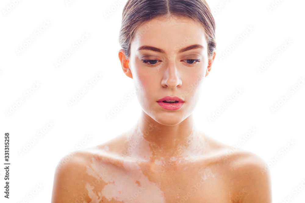 beautiful young brunette woman with vitiligo disease isolated on white positive smiling, model problems concept, bad tan real problem beautiful young brunette woman with vitiligo disease isolated on white positive smiling, model problems concept, bad tan real problem